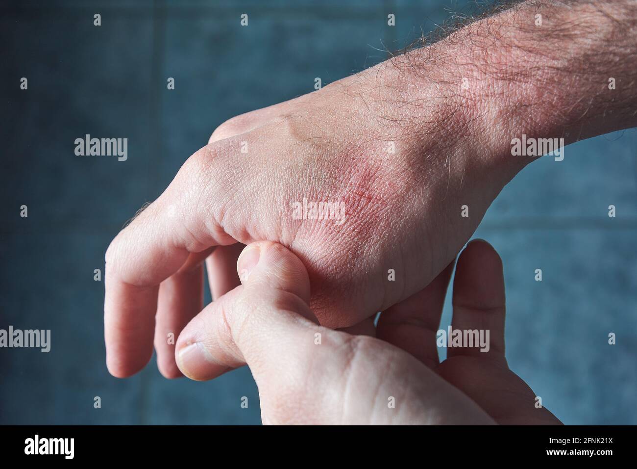 Giovane adulto che controlla la sua mano seccata con cracked, ferito pelle rossa. Foto Stock