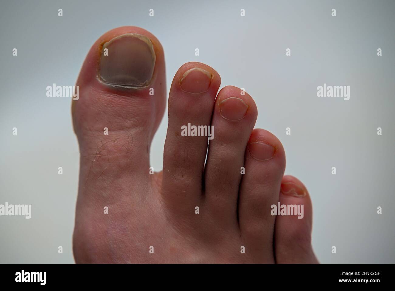 Trauma dell'unghia del piede immagini e fotografie stock ad alta  risoluzione - Alamy