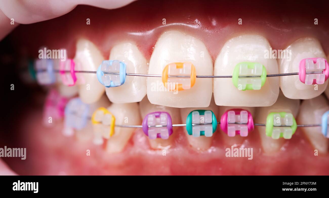 Macro istantanea di denti e bretelle in ceramica con fasce colorate in  gomma su di essi. Concetto di odontoiatria e trattamento ortodontico Foto  stock - Alamy