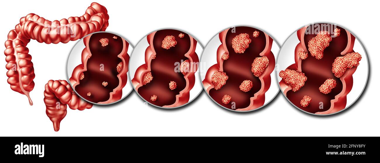 Cancro colorettale o concetto di malattia del colon come illustrazione medica con diversi stadi di cancro in un intestino crasso con un tumore maligno. Foto Stock