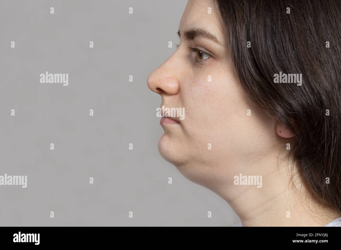 La donna ha un doppio mento. Trattamento, rimodellatura del mento, rimozione del grasso, sollevamento. Posizione per lo spazio di copia del testo Foto Stock
