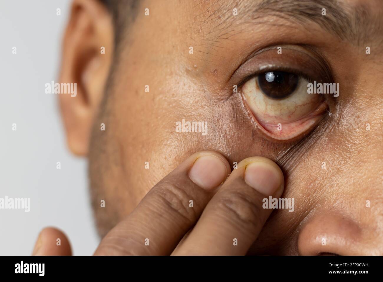 Primo piano di occhio giallo teso con il dito di un maschio indiano, concetto di assistenza sanitaria Foto Stock