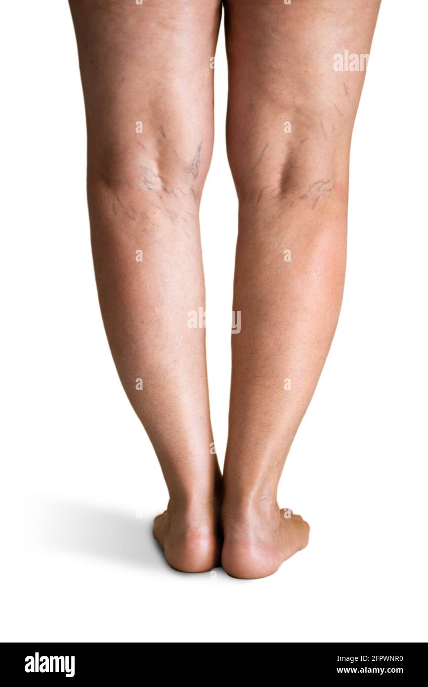 Malattia varicosa della vena della gamba e dolore. Problema di pressione sanguigna Foto Stock