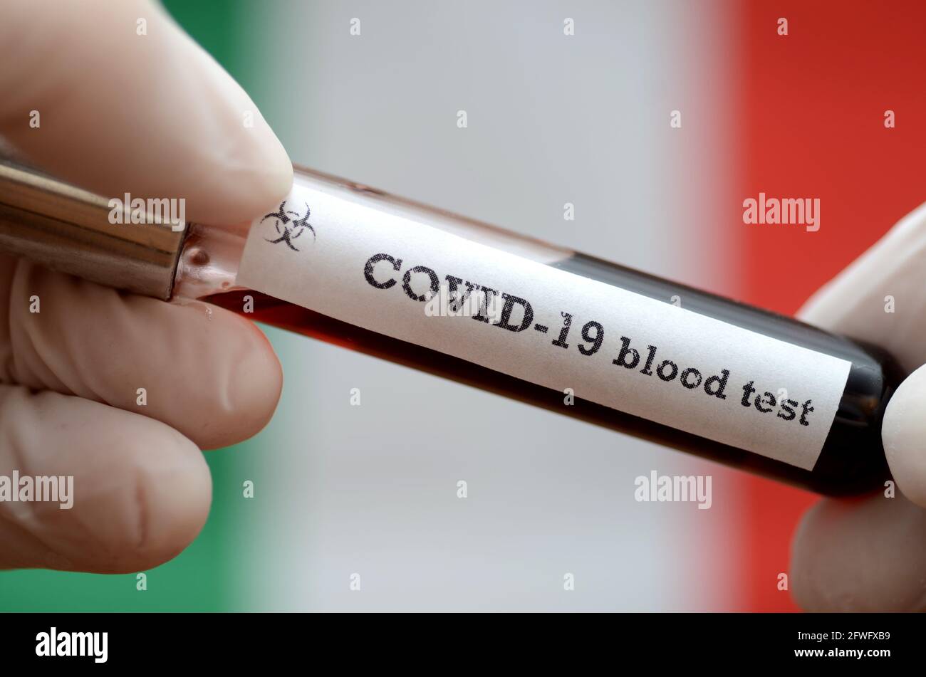Campione di sangue di Coronavirus 2019-nCoV. Virus epidemico sindrome respiratoria stock foto . Focolaio del virus corona in Italia. Foto Stock