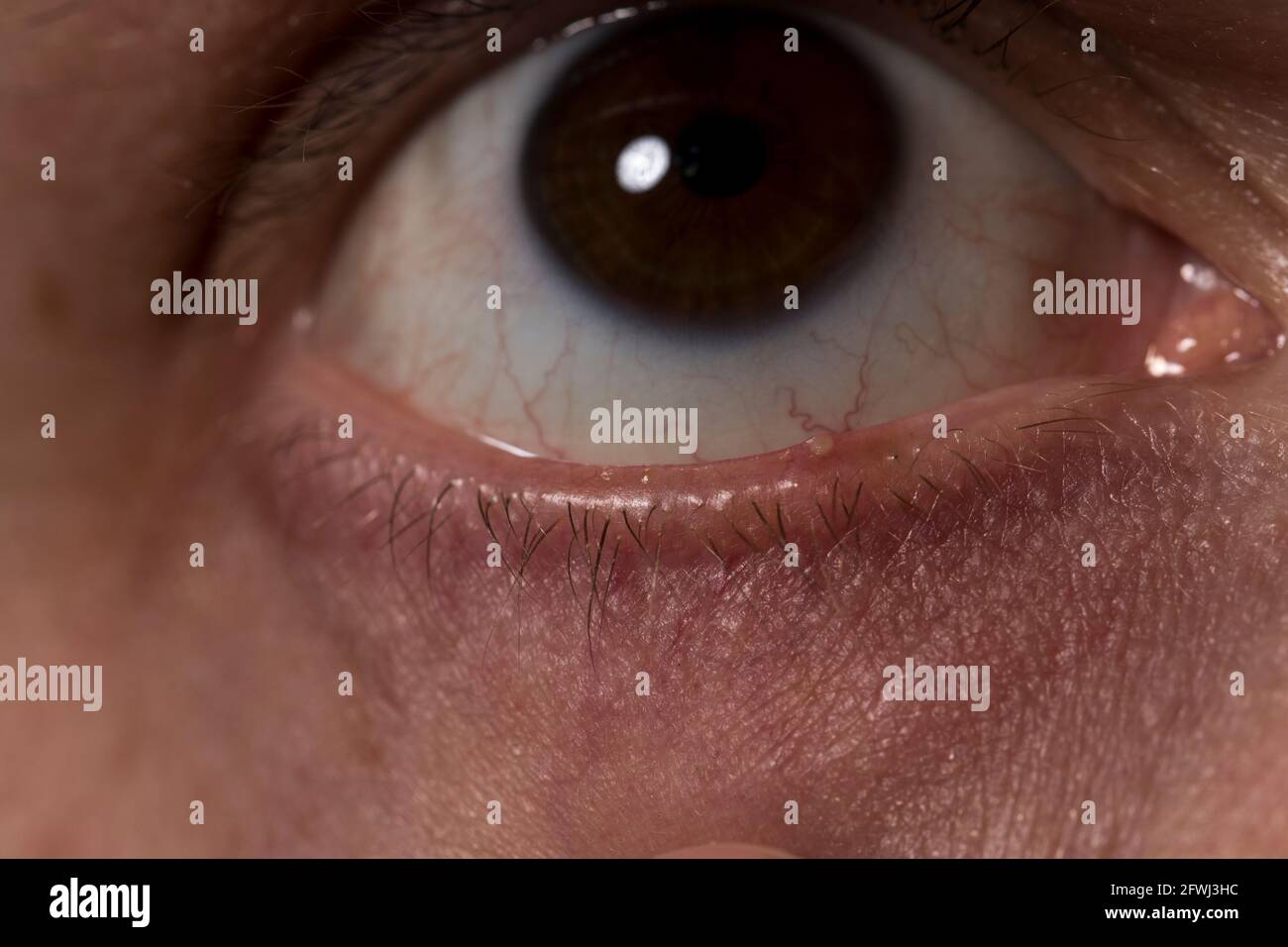 Stile infezione sul coperchio dell'occhio close up con pus pimple sul coperchio dell'occhio inferiore. Foto Stock