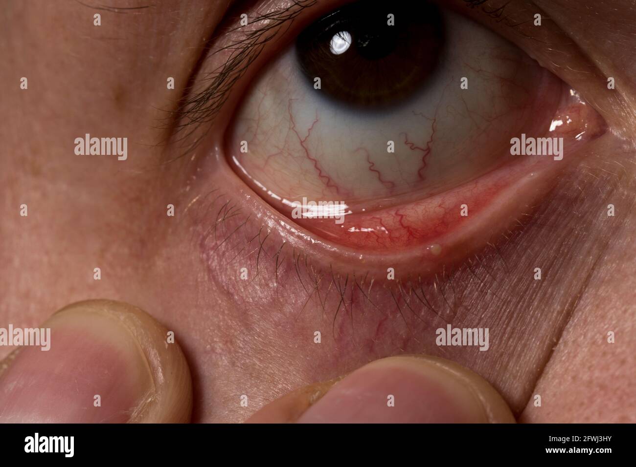 Occhio stye ravvicinato su infezione degli occhi pus. Infezione da Chalaione causata da follicolo dei capelli intasato nel coperchio degli occhi. Foto Stock