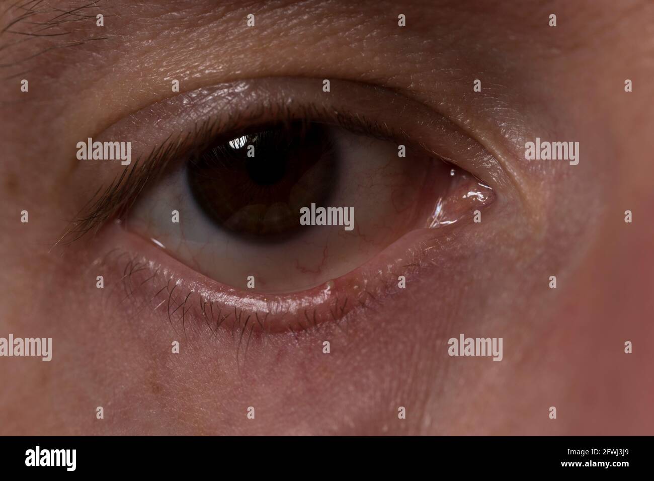Eye style close up infezione oculare pimple con pus sul coperchio dell'occhio inferiore. Foto Stock