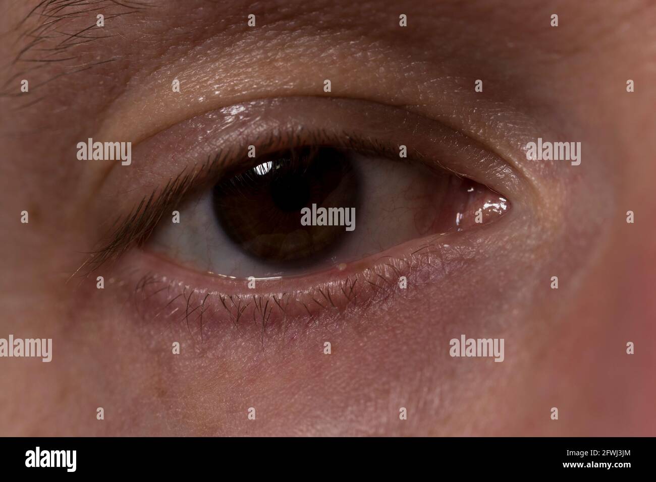 Stye close up infezione oculare pus sul coperchio dell'occhio inferiore da infezione da calazione. Foto Stock