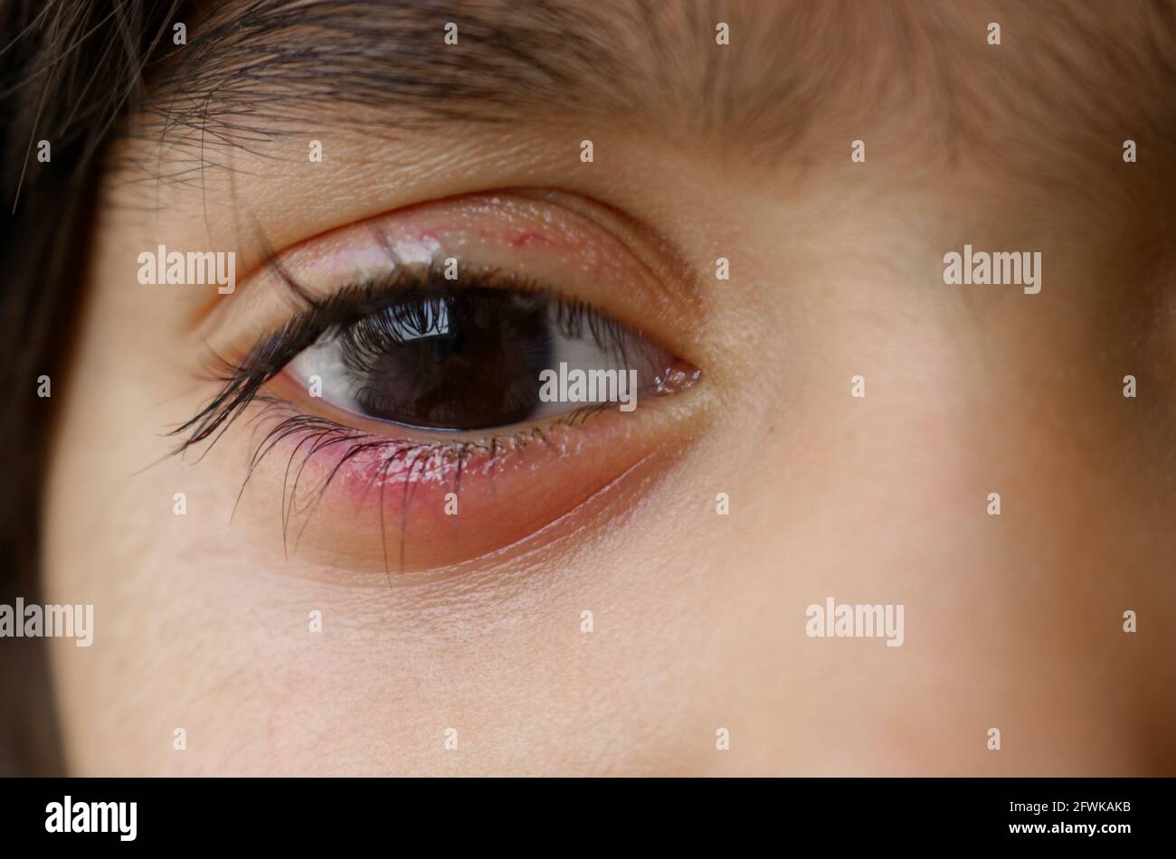 Palpebra palpabile di una bambina, gonfiore oculare di un bambino, infezione oculare Foto Stock
