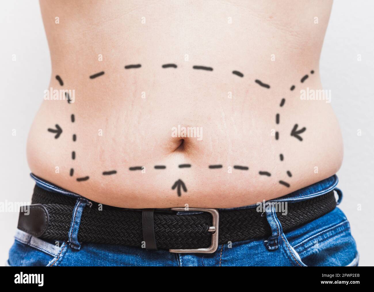 Il ventre di un uomo grasso irriconoscibile con linee dipinte e frecce per la liposuzione. Foto Stock