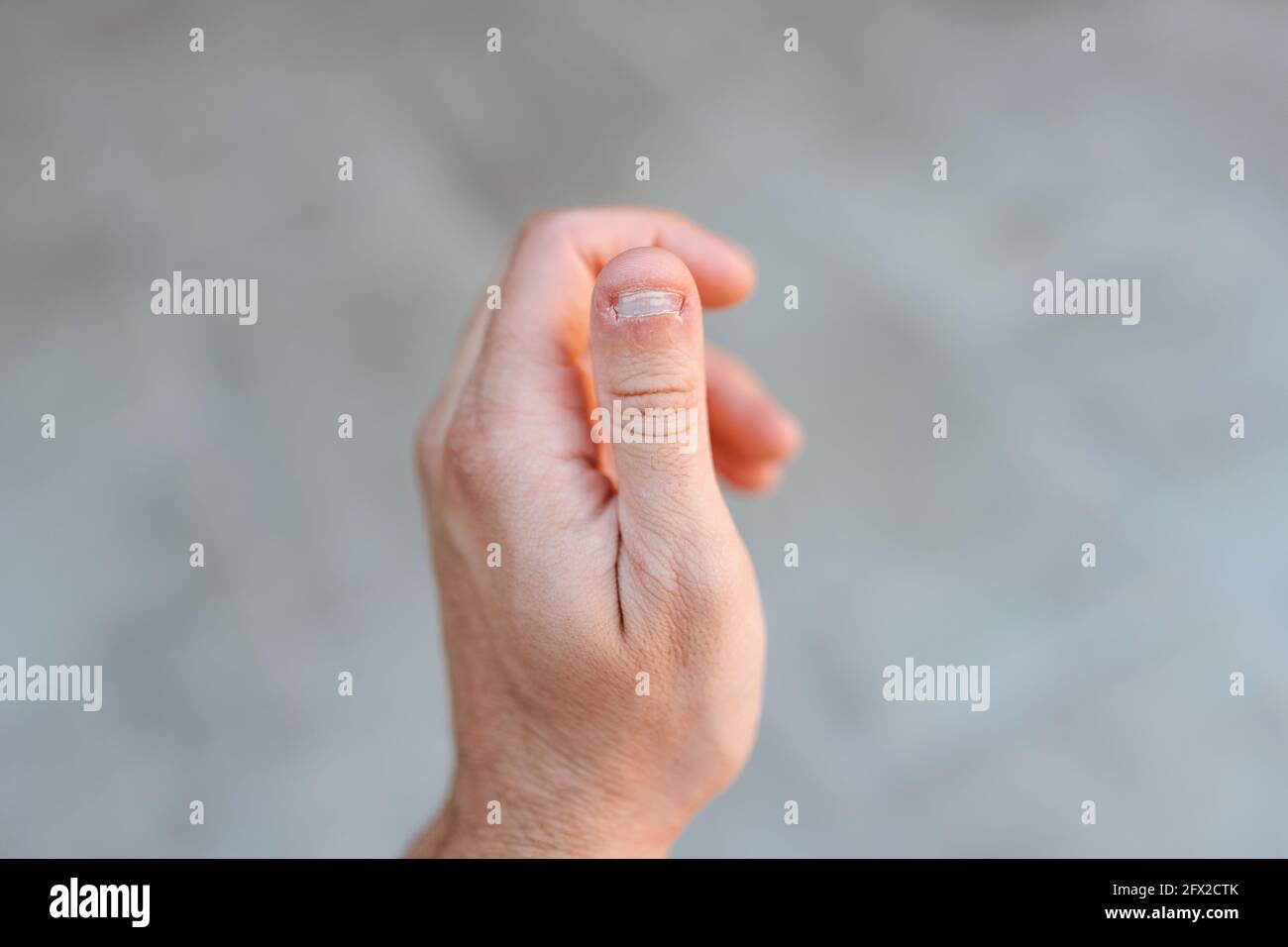 Primo piano dettaglio di una mano sinistra che mostra un pollice con un chiodo bianco e morso Foto Stock