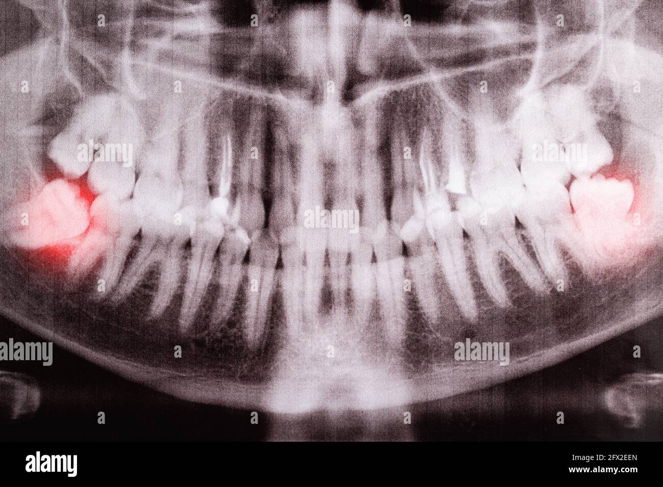 Ha influenzato i denti di saggezza su un'immagine a raggi X con un neoplasma della cisti infiammato. Rimozione dei denti di saggezza in odontoiatria Foto Stock