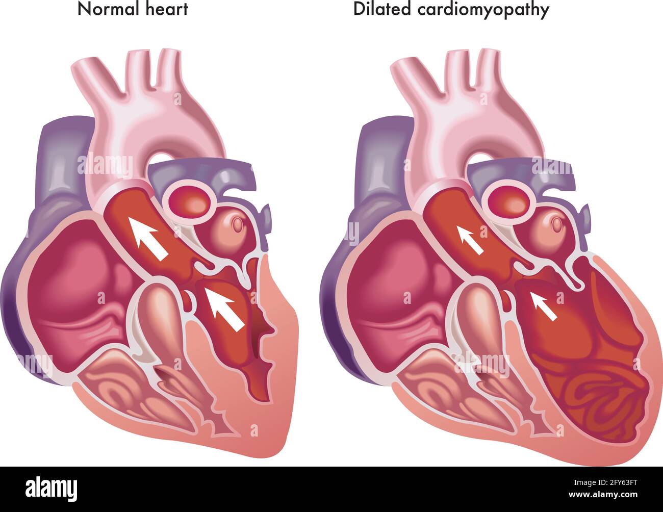 Illustrazione medica degli effetti della cardiomiopatia dilatata. Illustrazione Vettoriale