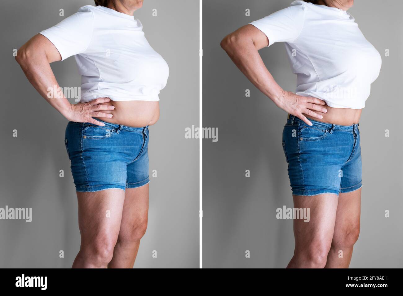 Prima e dopo la perdita di peso Liposuzione Chirurgia Foto Stock