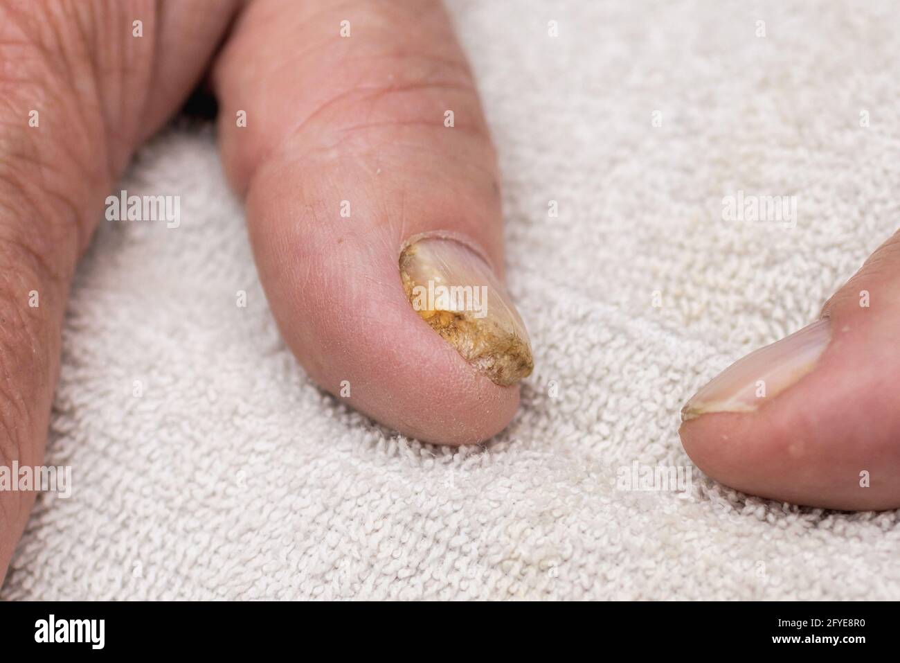 Infezione fungo del chiodo sul dito grande. Infezione fungina sulle unghie mano, dito con onicomicosi.Close up. Foto Stock
