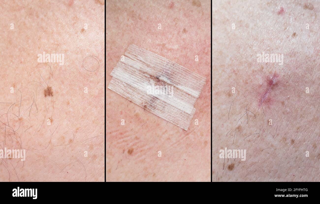 Cicatrice a seguito della rimozione di una talpa. Foto Stock
