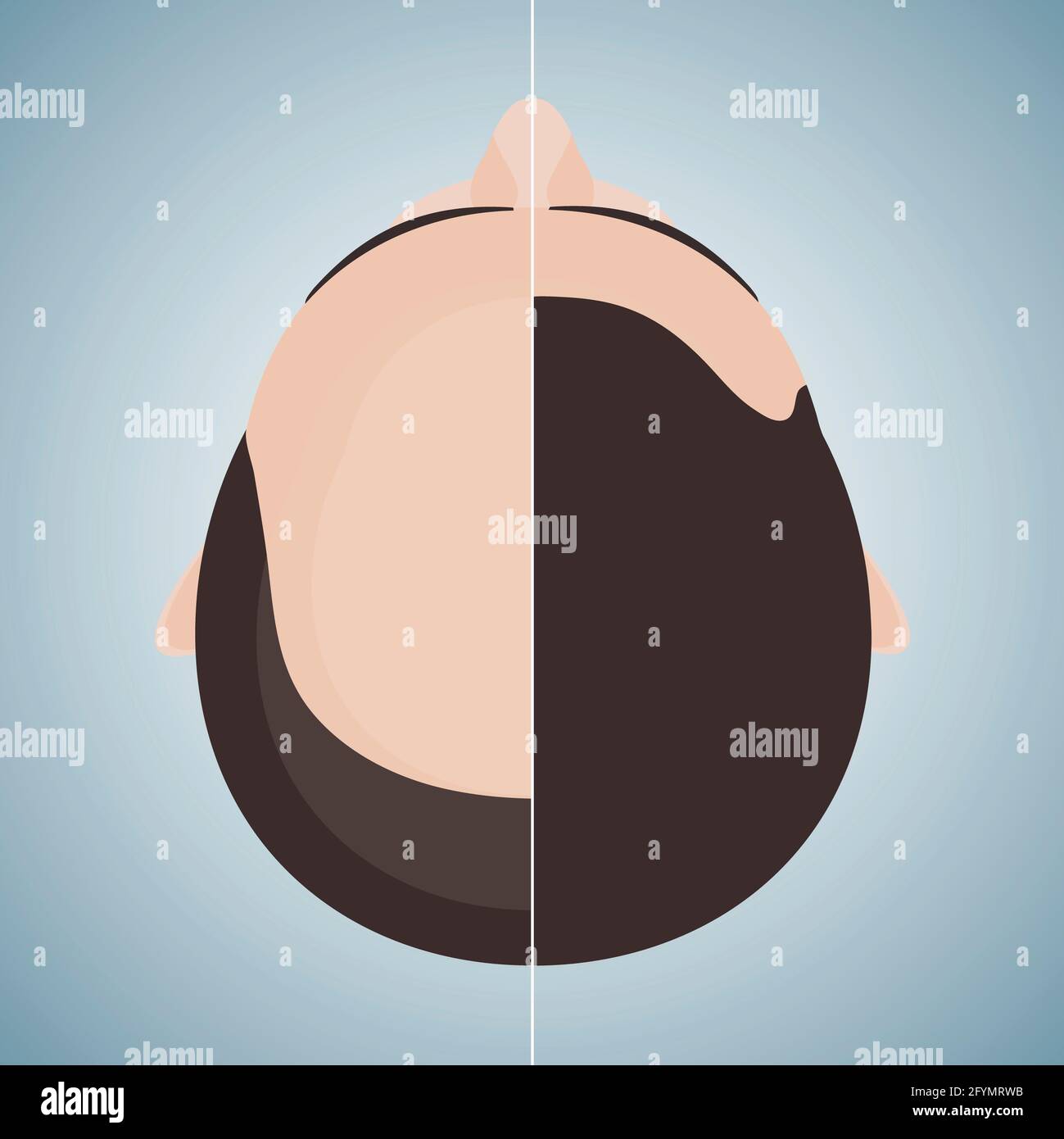 Trattamento di perdita dei capelli per gli uomini, illustrazione concettuale Foto Stock