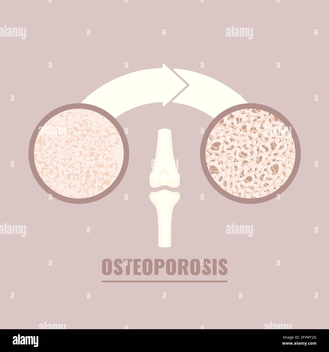 Osteoporosi, illustrazione concettuale Foto Stock