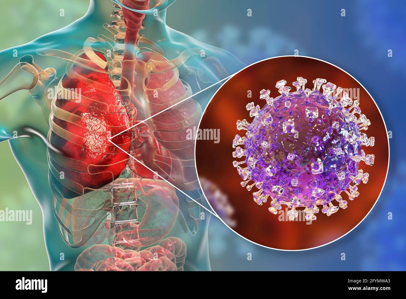Virus Nipah nei polmoni, illustrazione Foto Stock