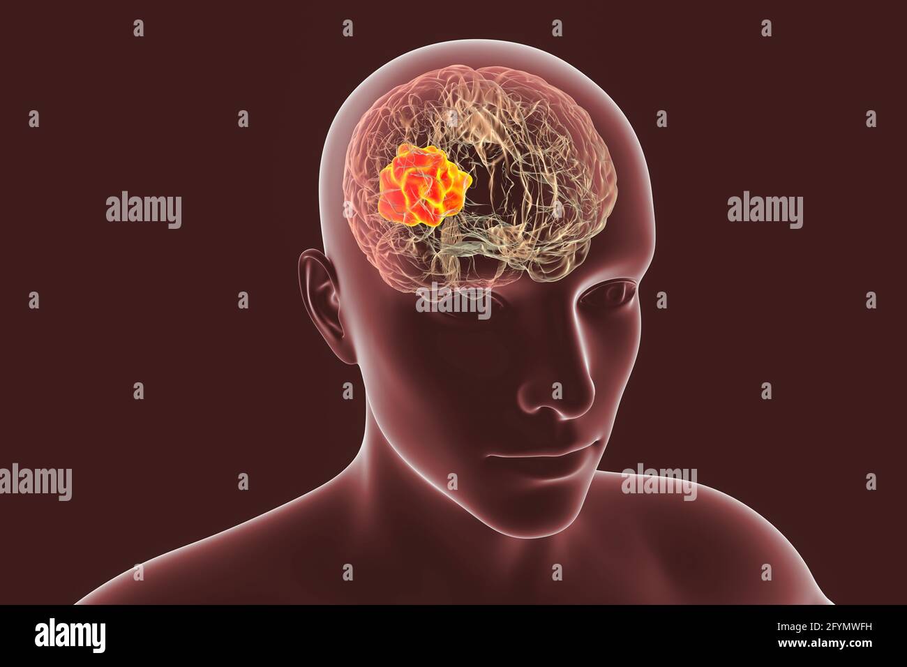 Mucormicosi cerebrale, illustrazione Foto Stock