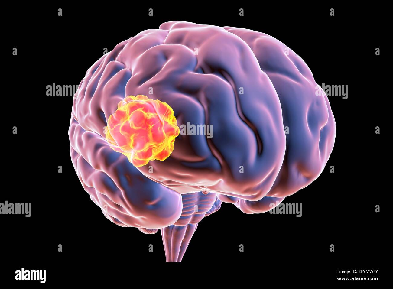 Mucormicosi cerebrale, illustrazione Foto Stock