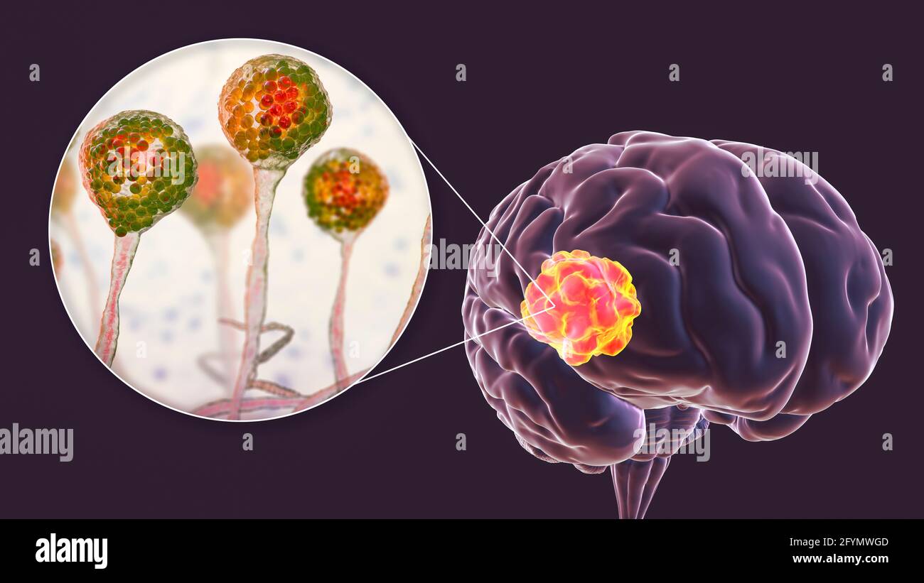 Mucormicosi cerebrale, illustrazione Foto Stock