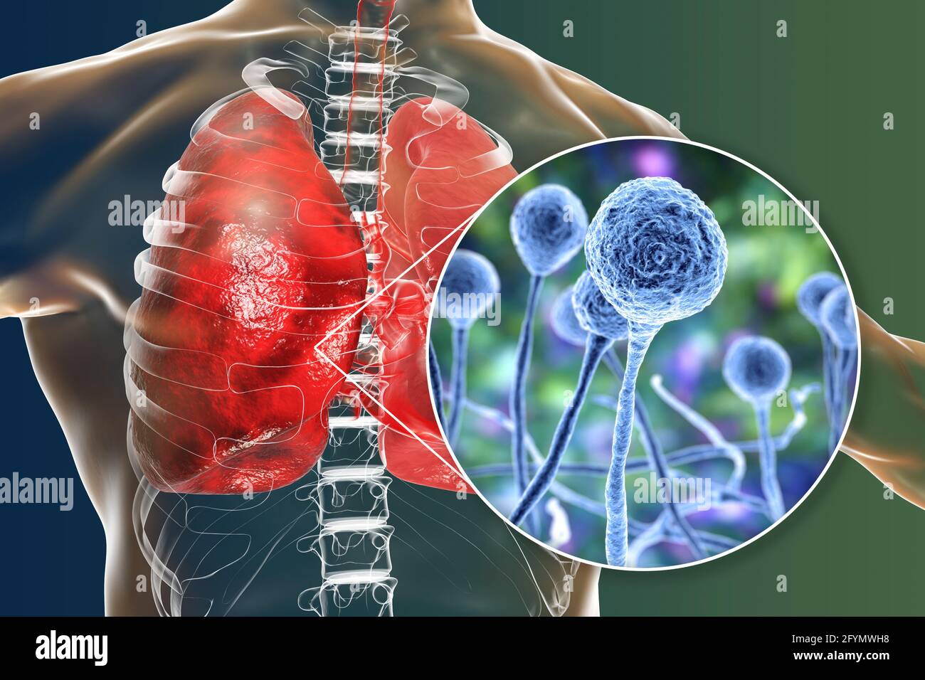 Mucormicosi polmonare, illustrazione Foto Stock