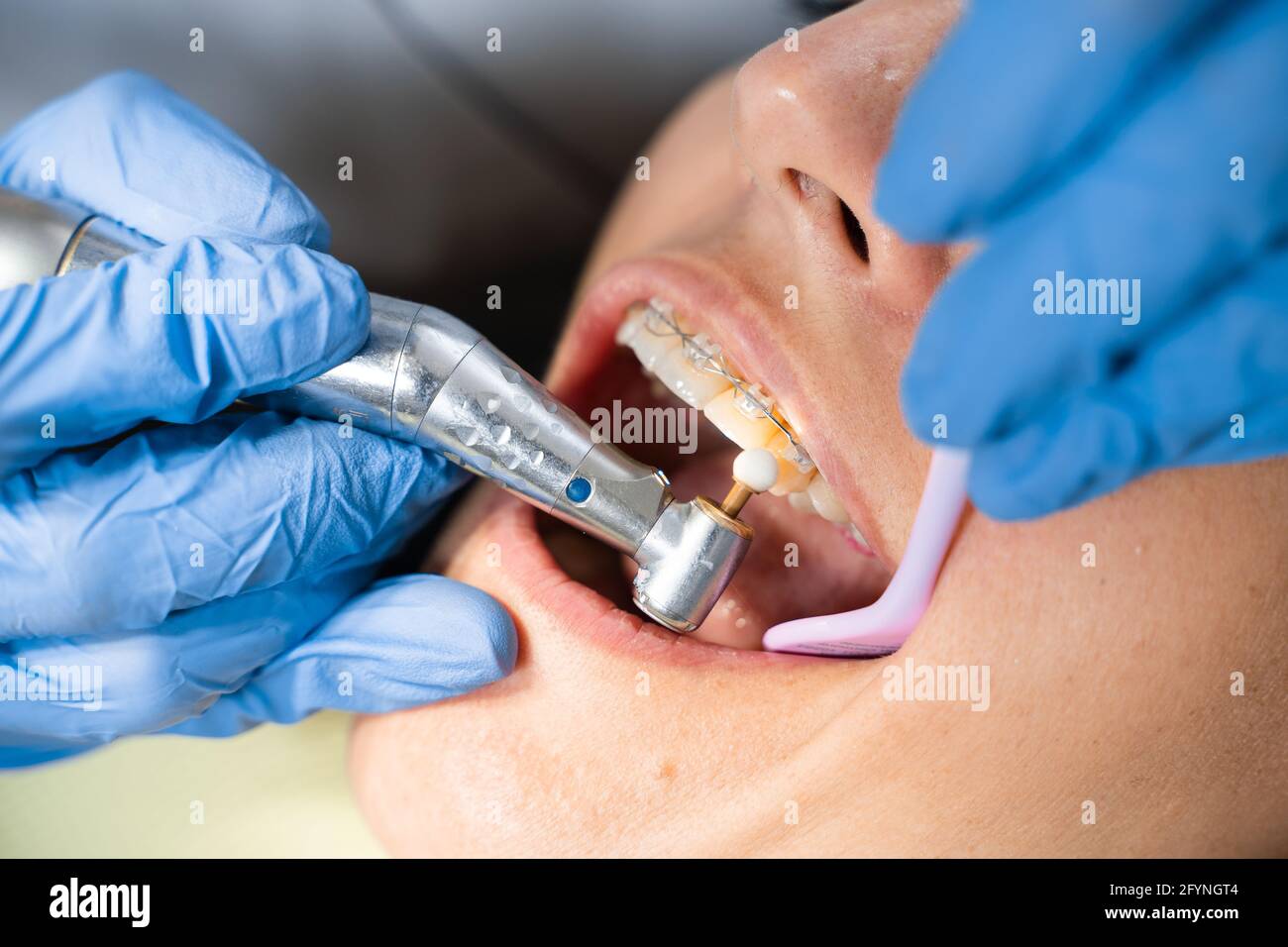 Trapano dentista e lucidare il dente. Procedura stomatologica per il  trattamento del mal di denti Foto stock - Alamy