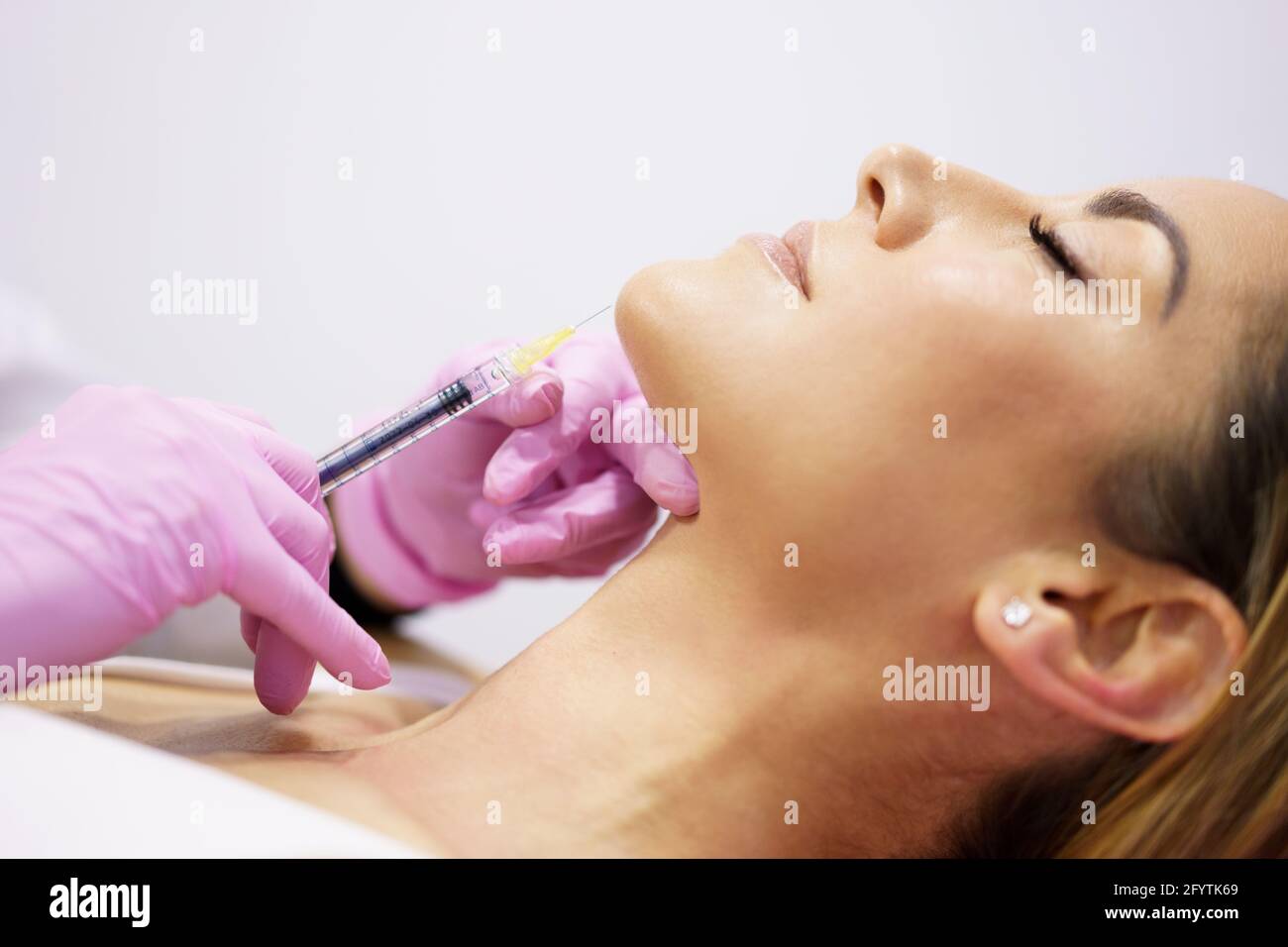 Medico iniettando acido ialuronico nel ching di una donna come trattamento di ringiovanimento facciale. Foto Stock
