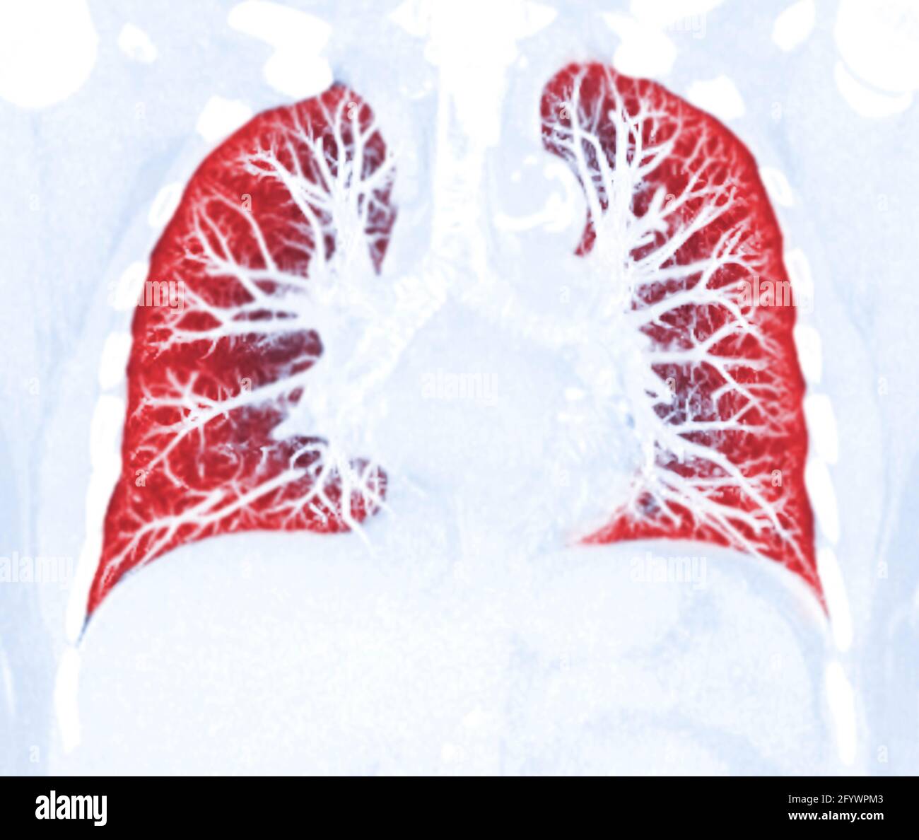 CT Chest Lung (polmone torace) preimpostato per la tubercolosi (TB) e il coronavirus 2019 rilevati. Foto Stock