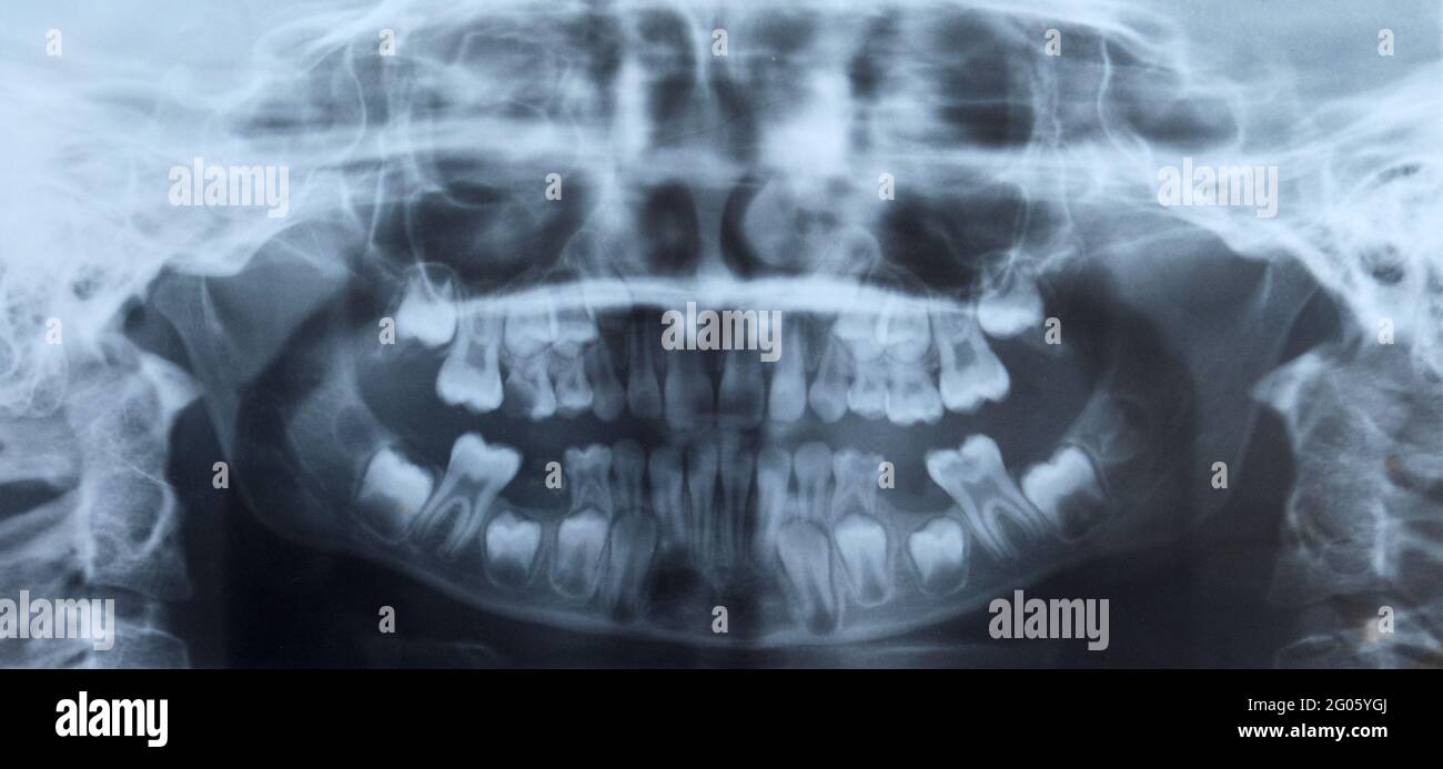 Radiografia dentale di un bambino Foto stock - Alamy