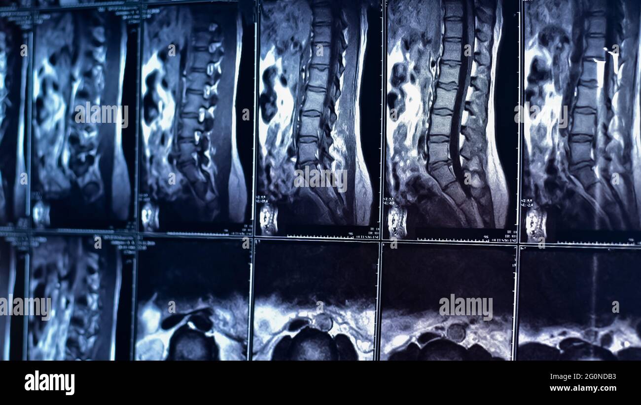 Imaging di risonanza magnetica della colonna lombare Foto stock - Alamy