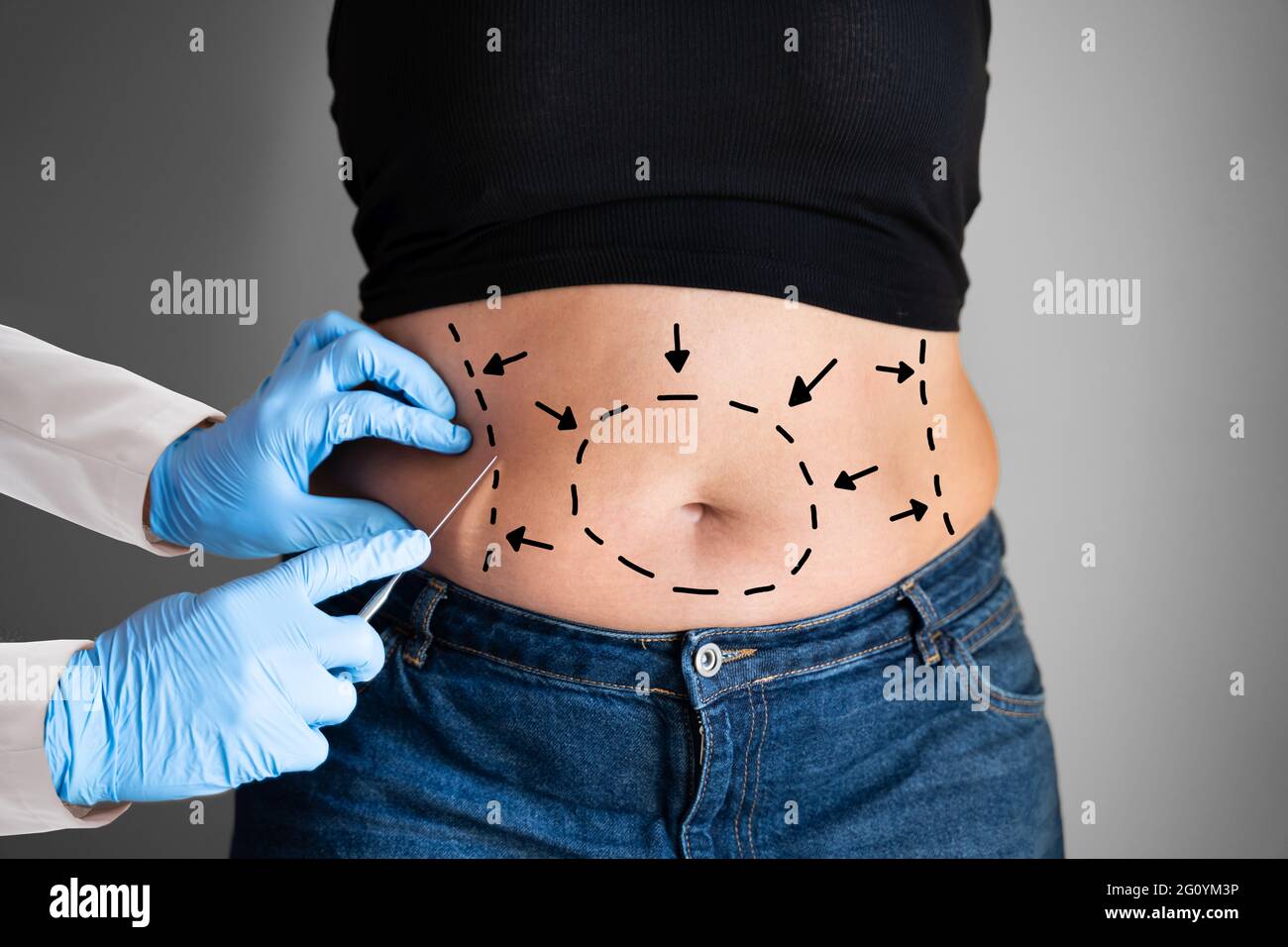 Chirurgia dell'obesità dell'abdominoplastica. Liposuzione estetica del grasso addominale Foto Stock