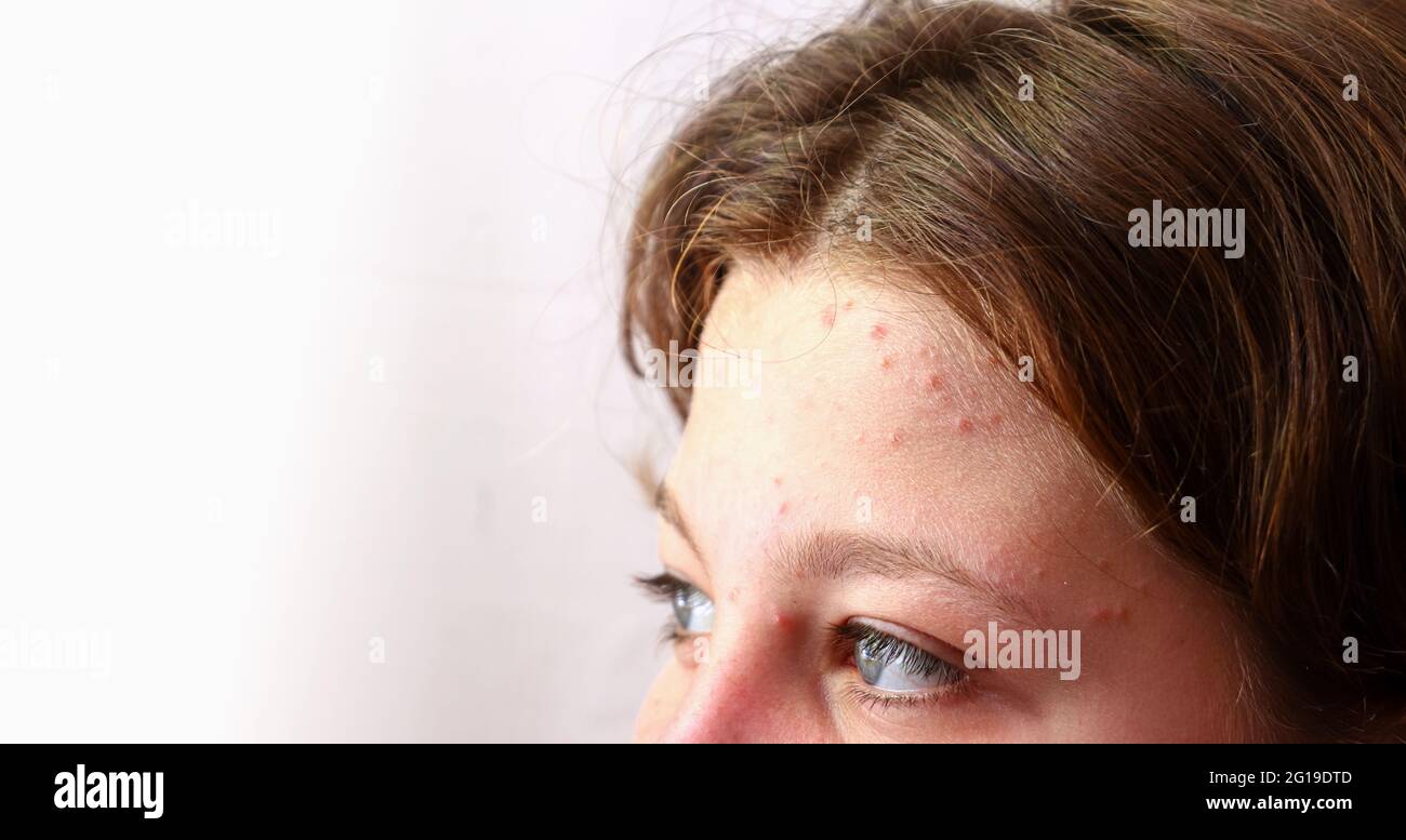 Fronte implorata. Ragazza teenager primo piano problema pelle sul viso. Occhi e fronte. Spazio di copia. Foto Stock
