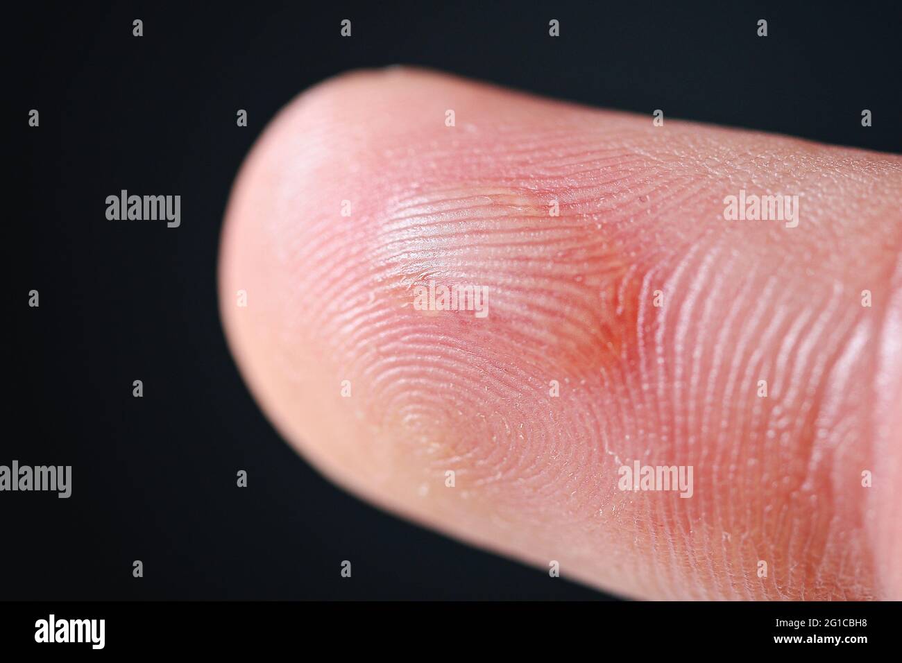 Callo sul dito medio della mano di un uomo Foto stock - Alamy