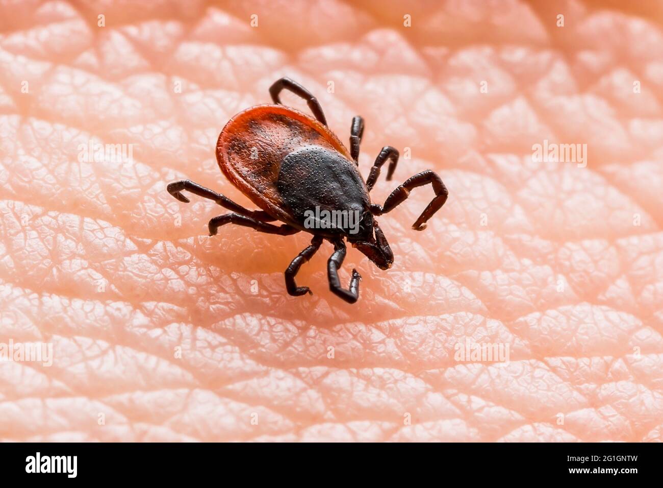 Encefalite infettiva Ixodes Scapularis o Persulcatus Deer Tick Insect sulla pelle. Encefalite virus o malattia di Lyme borreliosi infetta Ixodes Tick Foto Stock