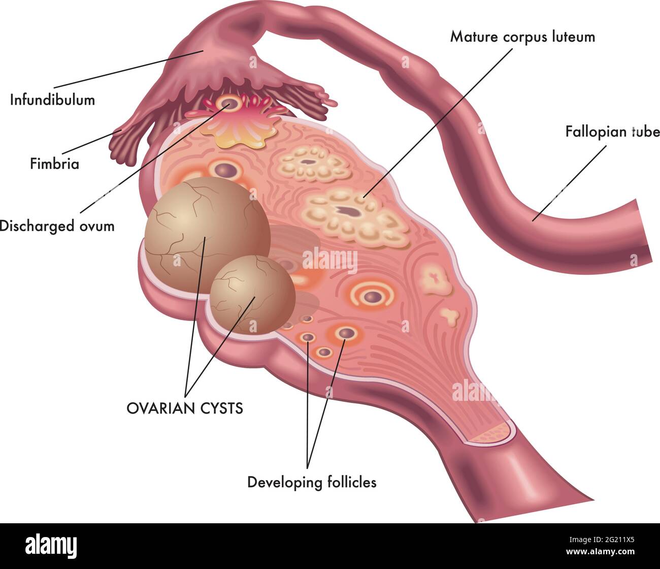 Illustrazione medica di una cisti ovarica e della sua posizione. Illustrazione Vettoriale