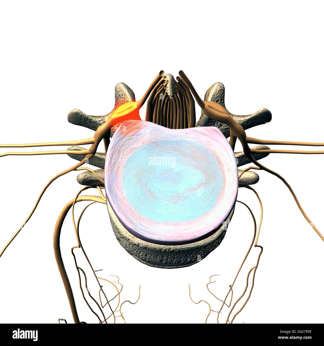 Un disco erniato che preme contro un nervo spinale, su sfondo bianco. Foto Stock