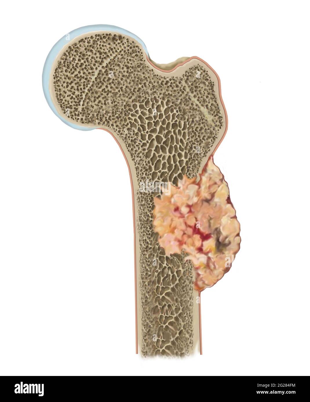 Particolare dell'osteosarcoma sul femore. Foto Stock