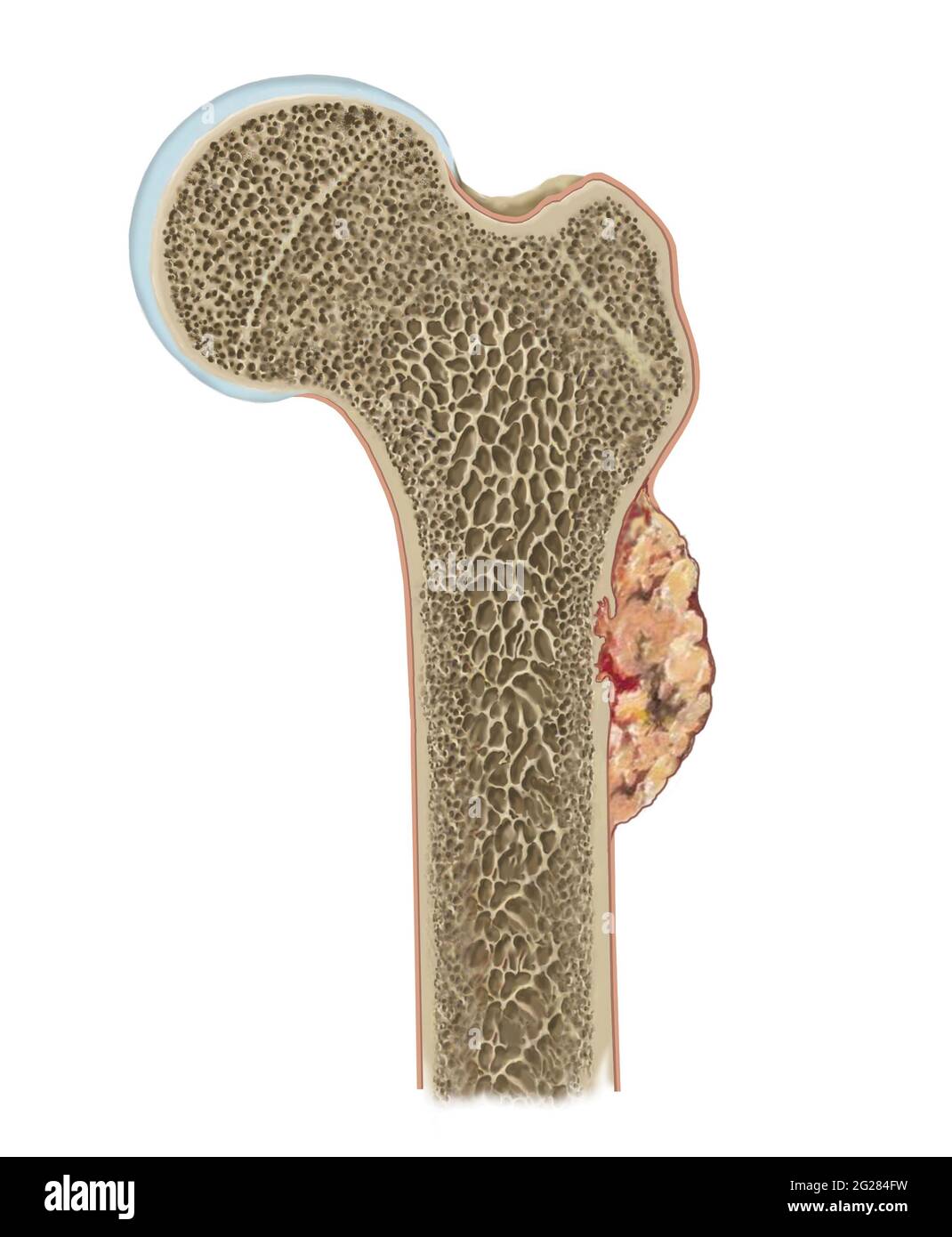 Particolare dell'osteosarcoma sul femore. Foto Stock
