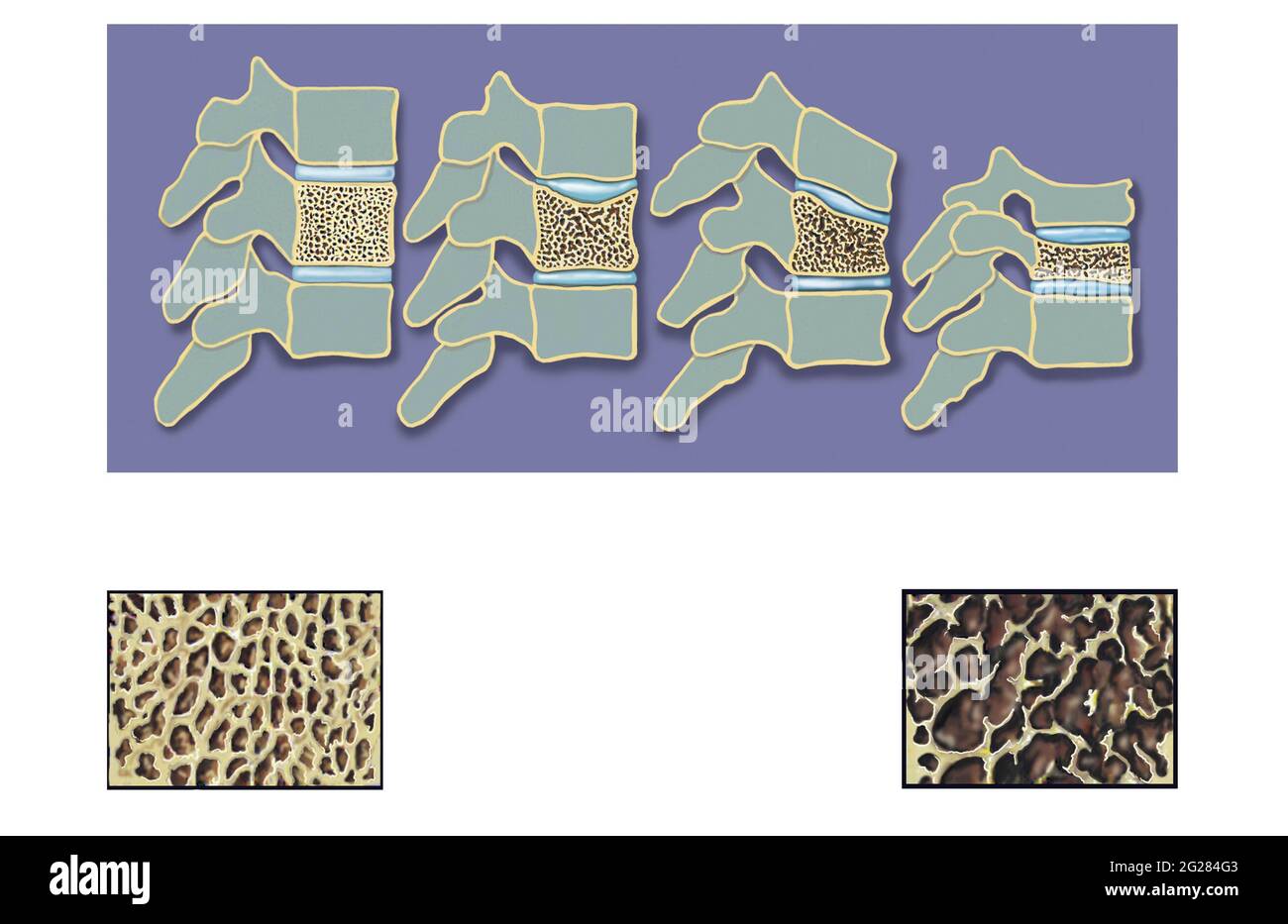 Collasso delle vertebre dovuto all'osteoporosi. Foto Stock