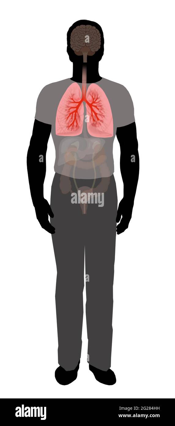 Silhouette maschile che mostra polmoni con bronchi e bronchioli infiammati. Foto Stock