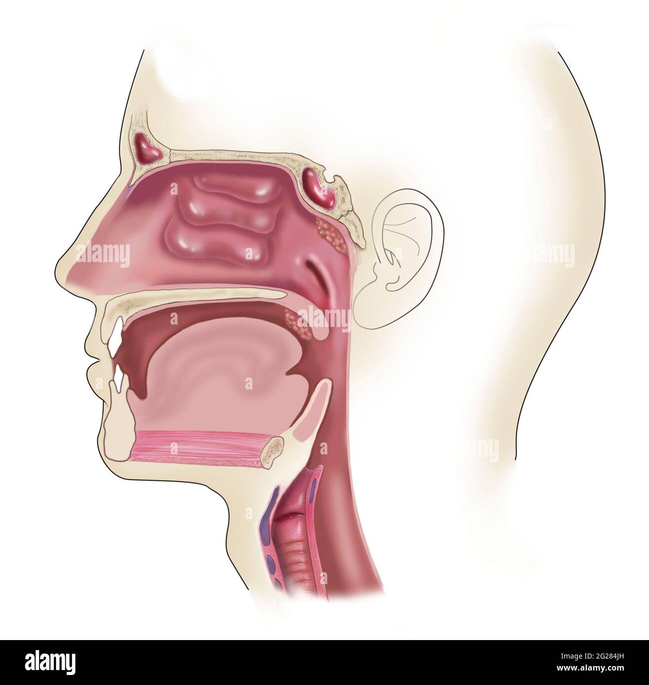 Vista laterale della testa che mostra la posizione delle tonsille gonfie e ingrandite. Foto Stock