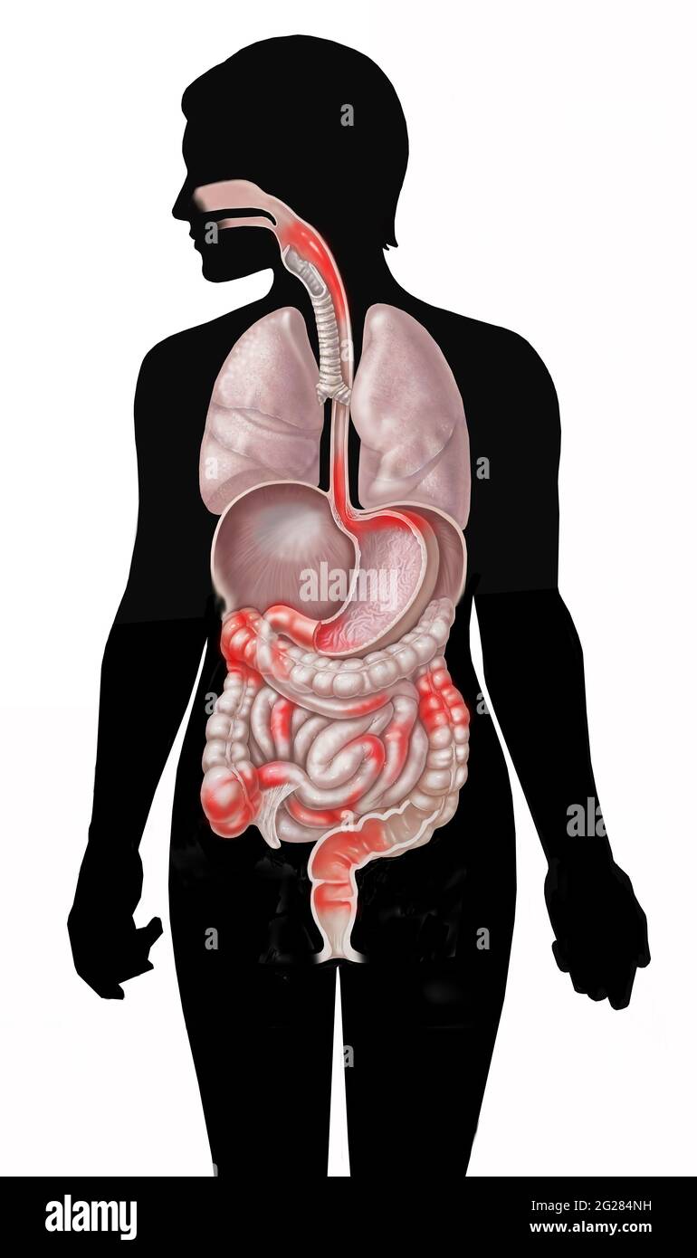 Posizioni comuni della malattia di Crohn nel sistema gastrointestinale sulla figura di silhouette. Foto Stock