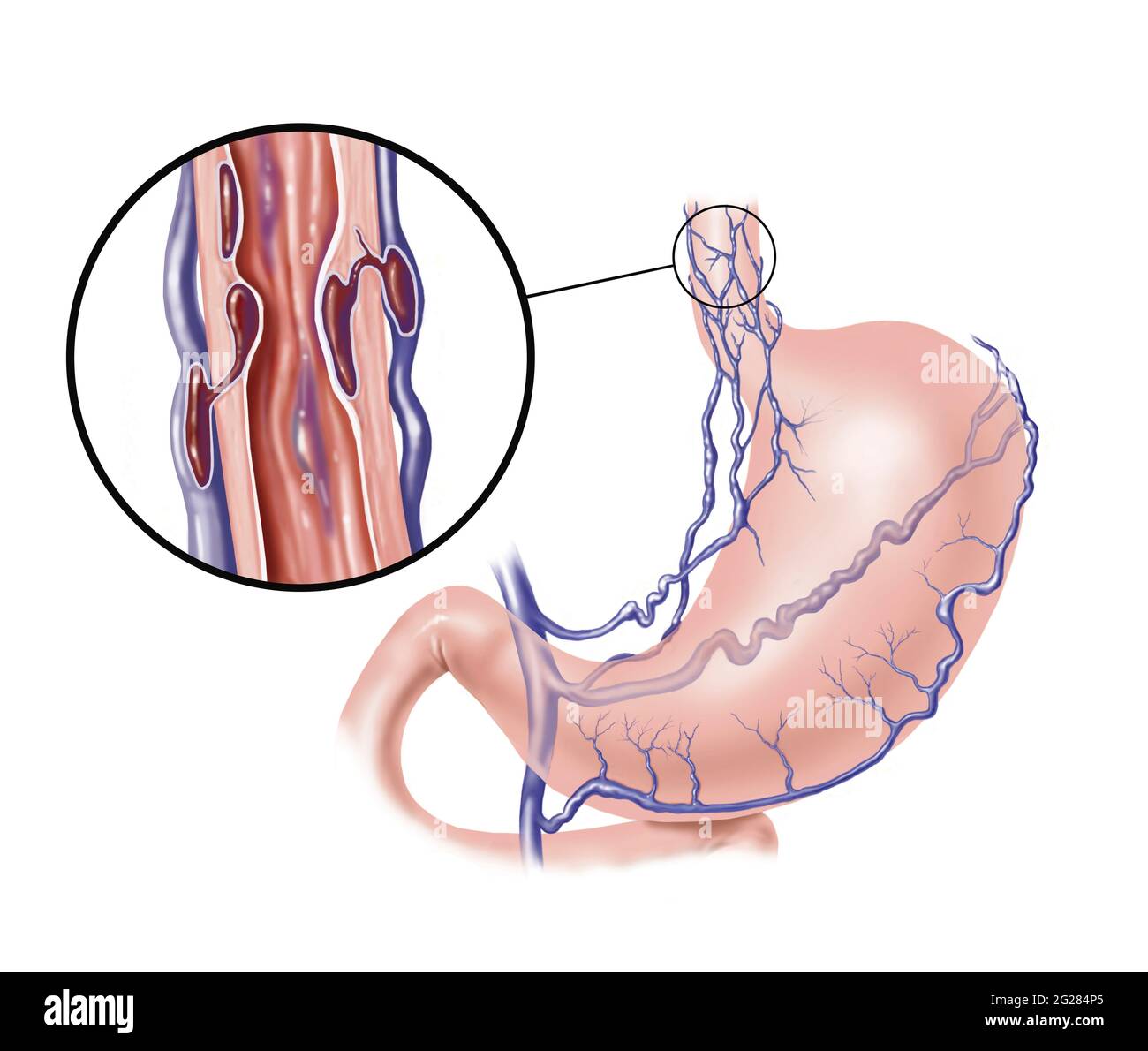 Varici esofagee su stomaco e esofago. Foto Stock