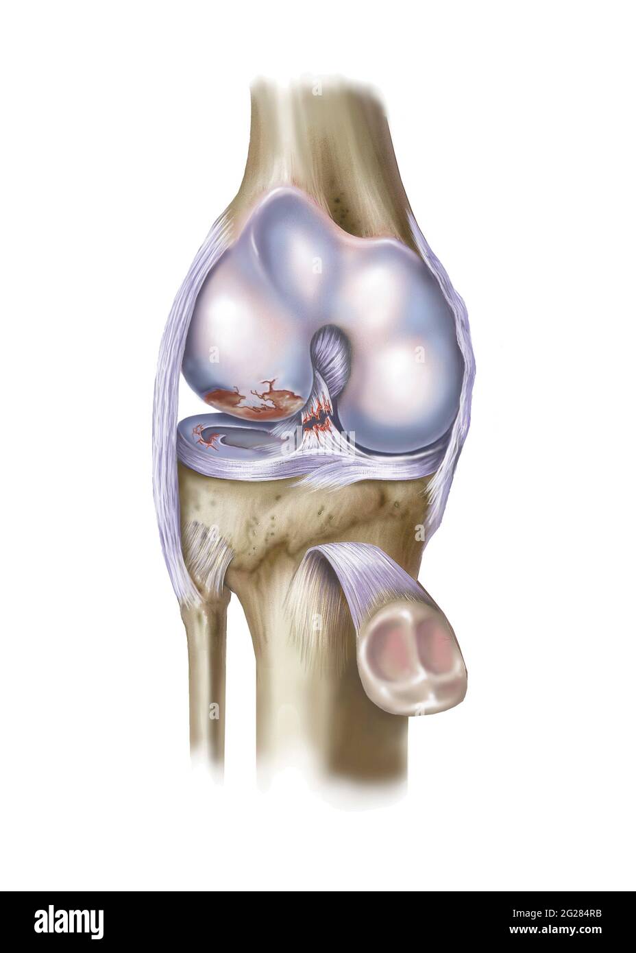 Vista frontale del ginocchio con LCA e menisco strappati. Foto Stock