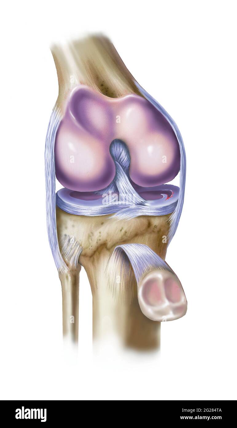 Vista frontale del ginocchio con menisco mediale strappato. Foto Stock