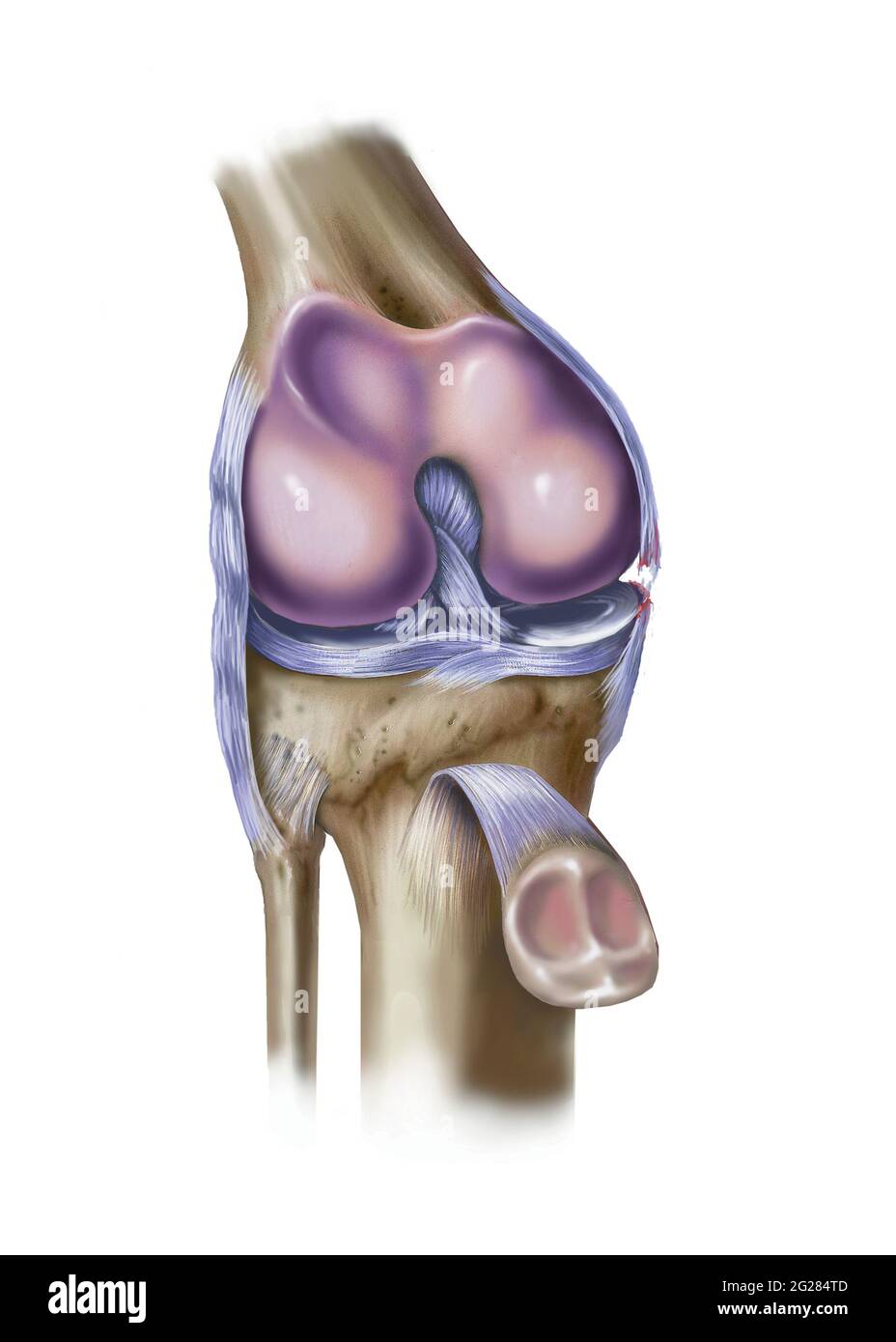 Vista frontale del ginocchio che mostra il legamento collaterale mediale strappato. Foto Stock