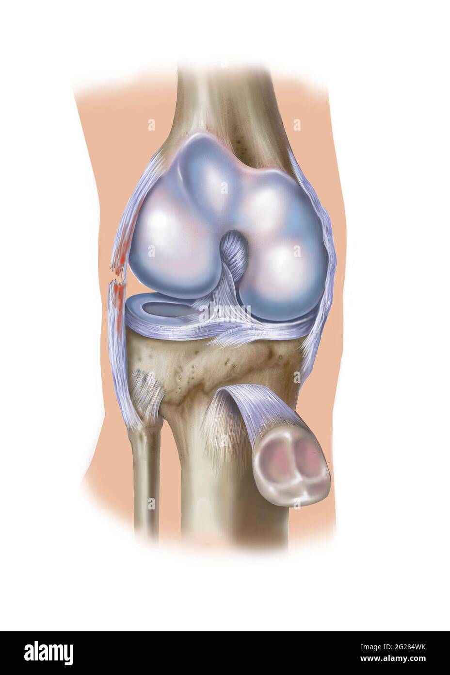 Vista frontale del ginocchio che mostra la lacerazione del legamento laterale. Foto Stock