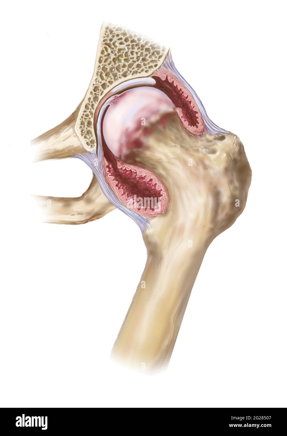 Artrite reumatoide nell'articolazione dell'anca, che mostra infiammazione della capsula e dei tessuti. Foto Stock